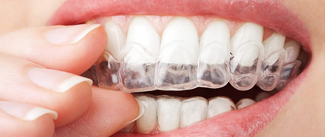 Escaneamento Intrabucal e confecção de alinhadores dentais